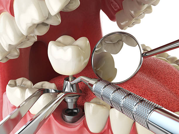 Best Emergency Tooth Extraction in Ganado, TX